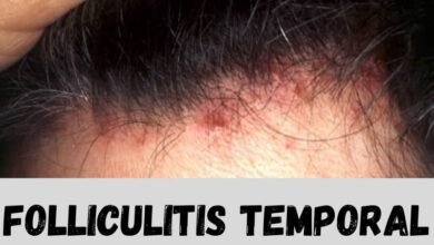 folliculitis temporal