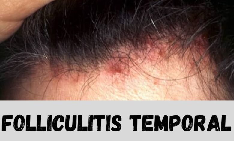 folliculitis temporal